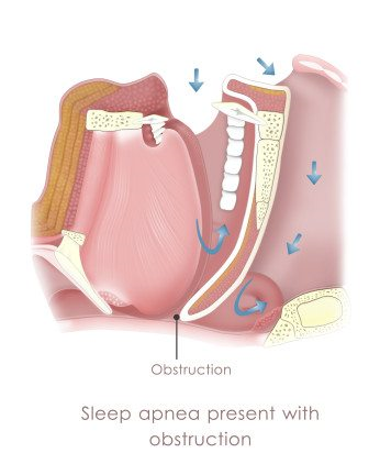 Sleep Apnea | Harrison Dental LLC | Portland Oregon